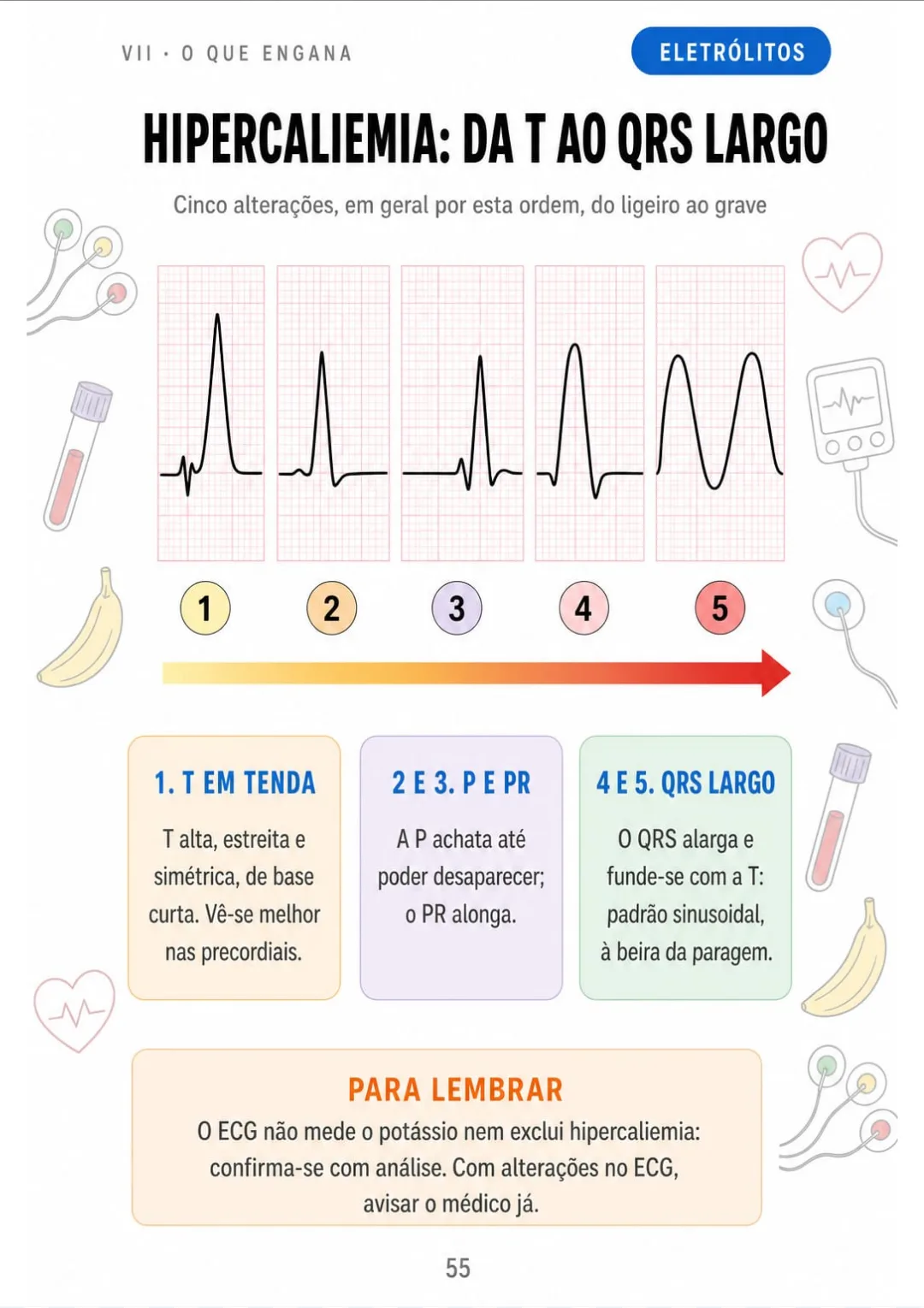 Hipercaliemia: T em tenda → P achatada → PR longo → QRS largo → padrão sinusoidal.