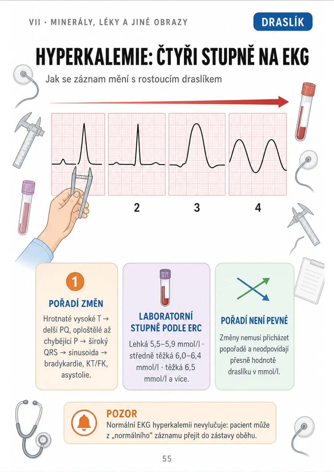 Hyperkalemie: hrotnaté T → oploštělé P → široký QRS → sinusoida; EKG neodpovídá přesně hladině draslíku.