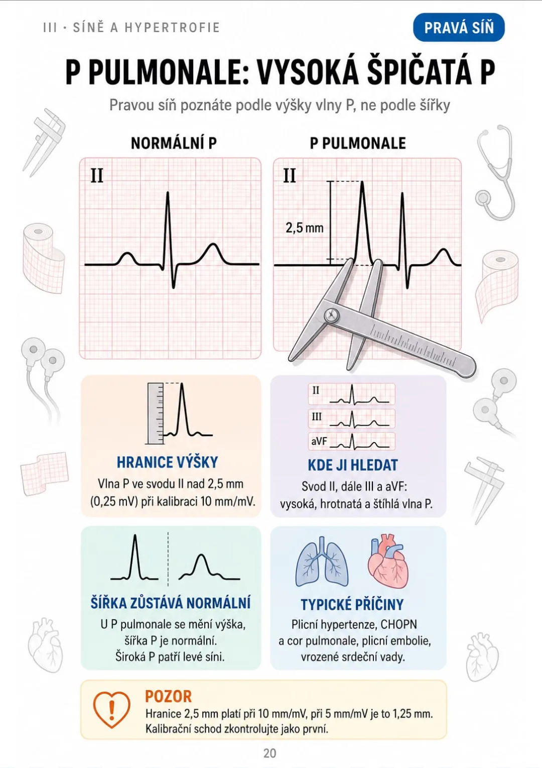 P pulmonale: vlna P ve II nad 2,5 mm, šířka normální.