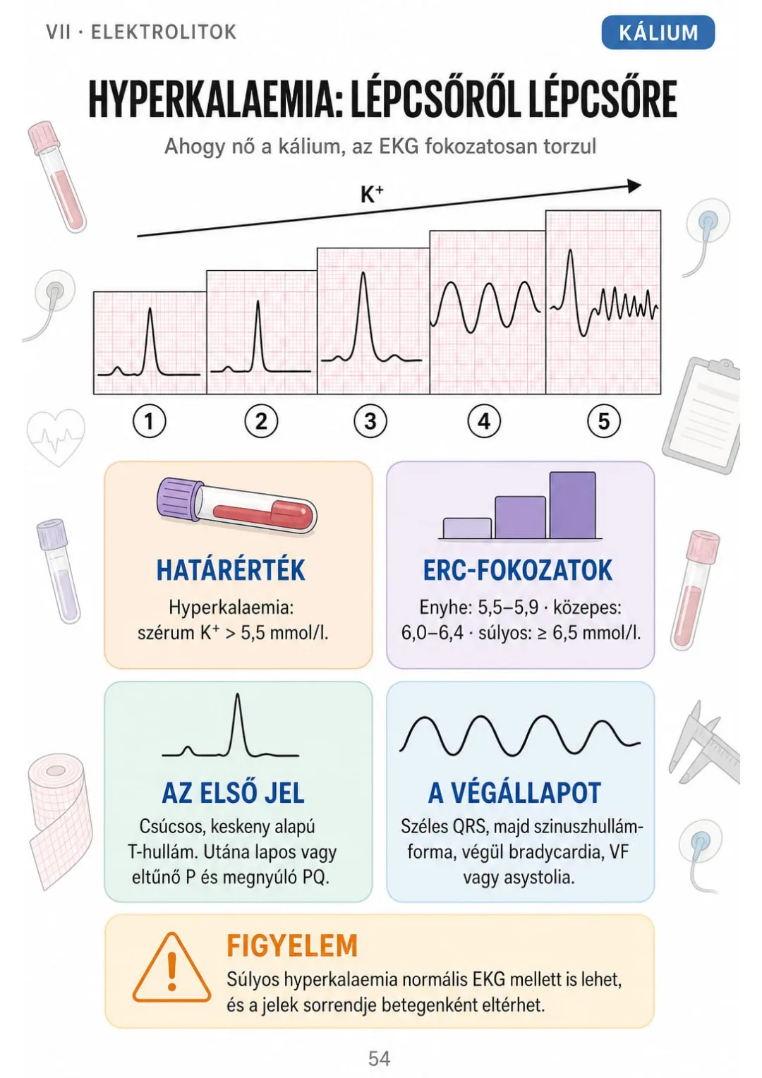 Hyperkalaemia: K+ > 5,5 mmol/l, súlyos ≥ 6,5 – öt EKG-fokozat egy rajzon