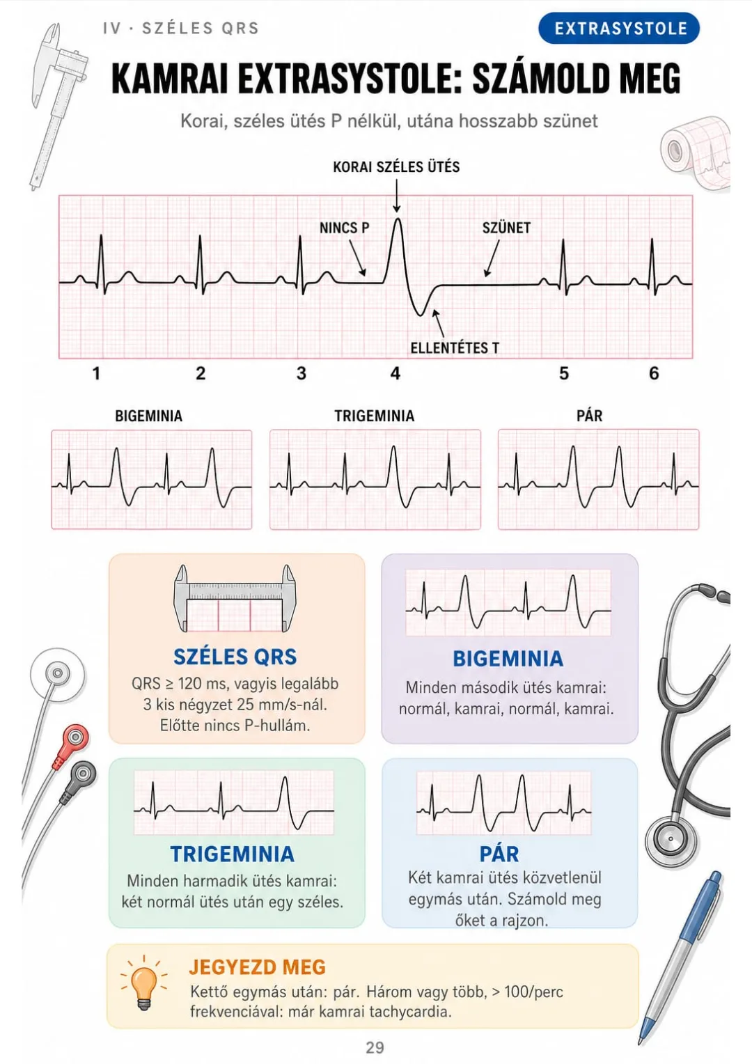 Kamrai extrasystole: QRS ≥ 120 ms, nincs előtte P, a T ellentétes irányú